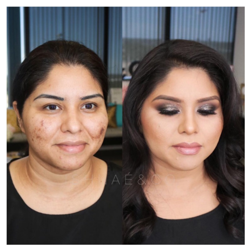 Acne Before And After 1