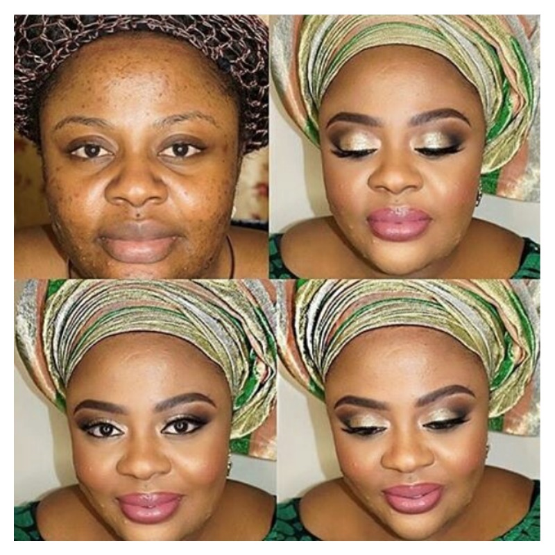 Acne Before And After 10