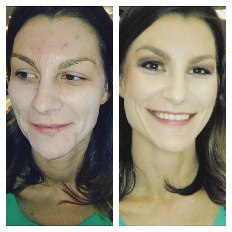 Acne Before And After 11