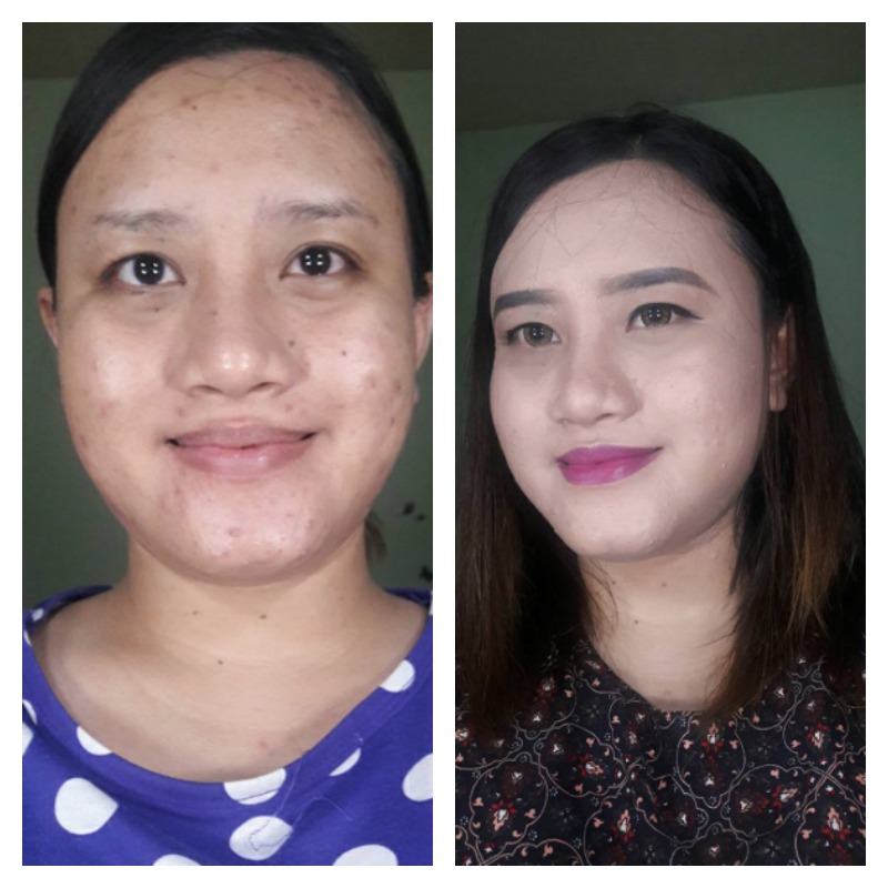 Acne Before And After 12