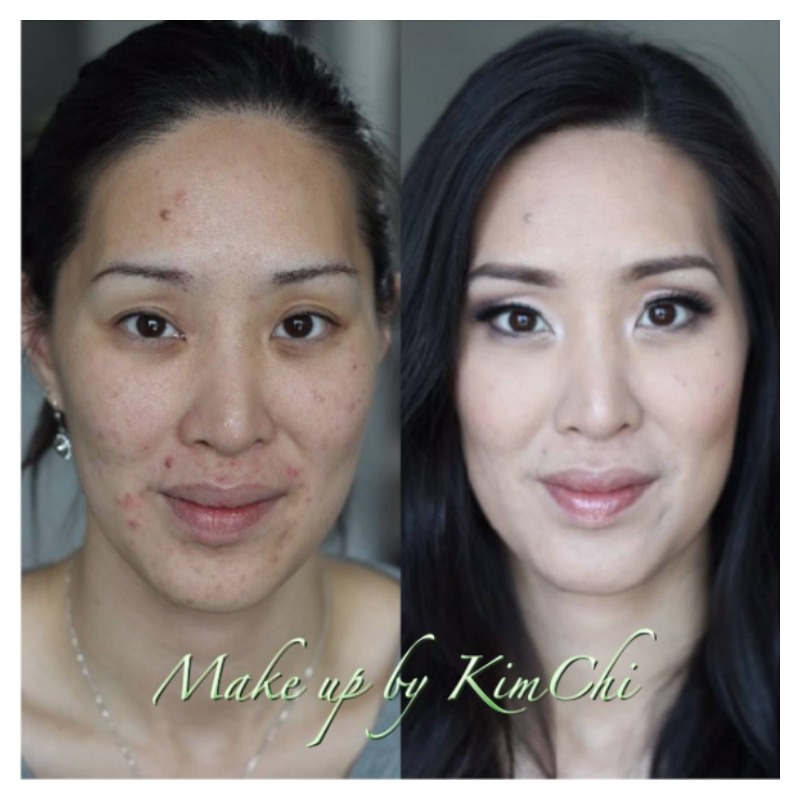 Acne Before And After 2