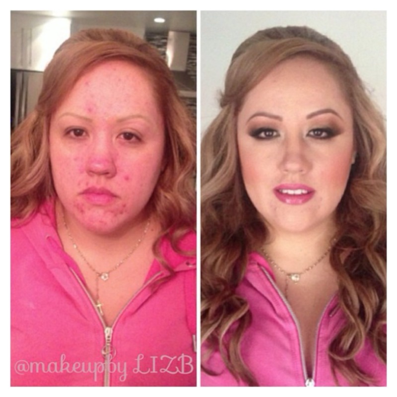 Acne Before And After 4