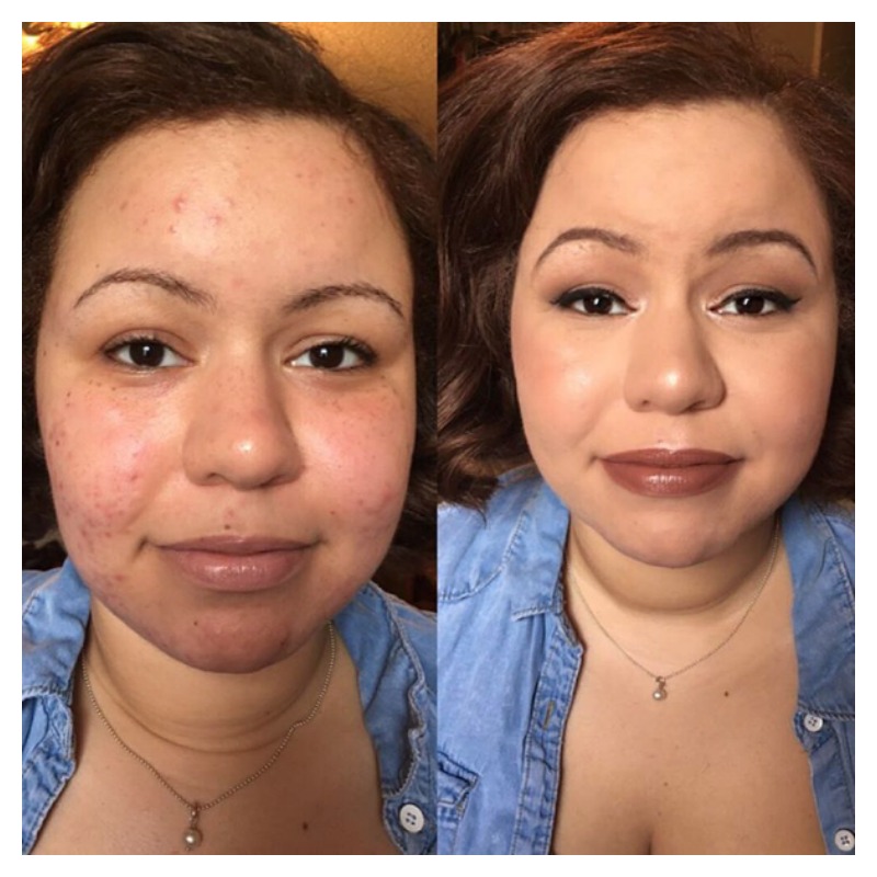 Acne Before And After 5