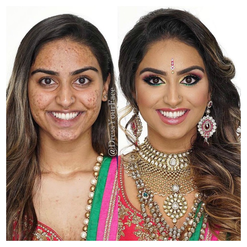 Acne Before And After 7