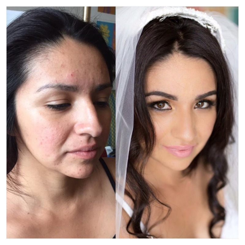 Acne Before And After 9