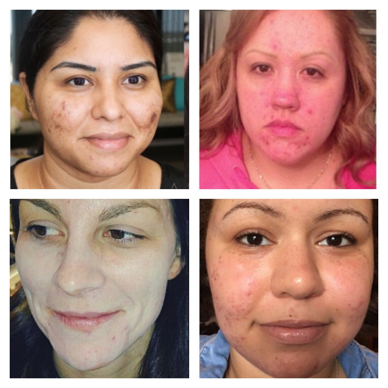 Acne Before And After