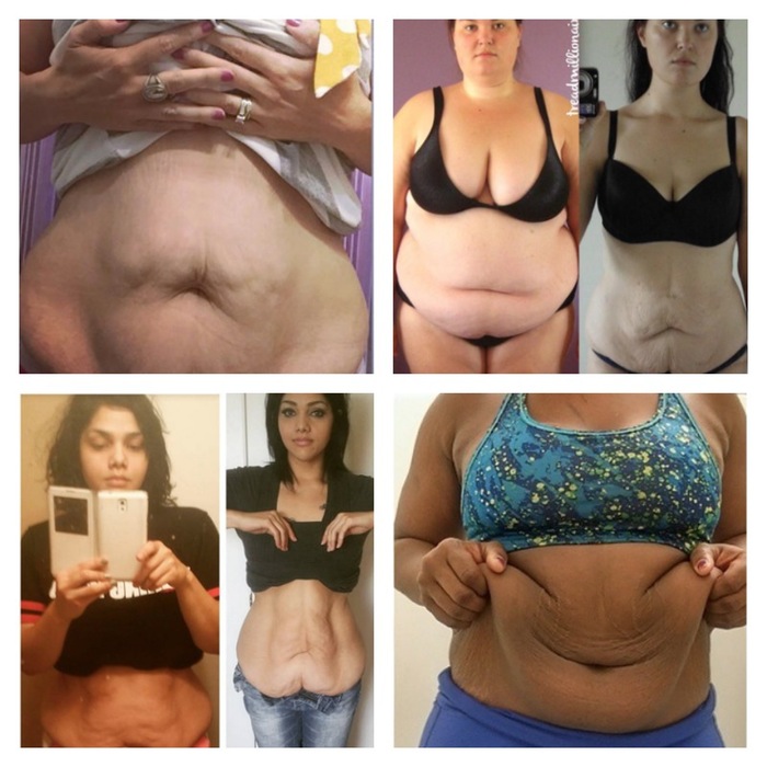 Excess Skin After Weight Loss Collage