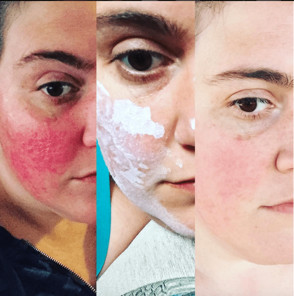 Milk of Magnesia Before and After Redness 1