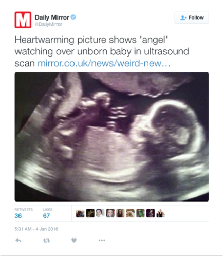 Ultrasound