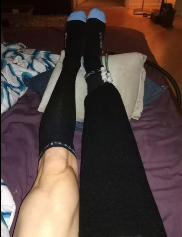 before and after photo of wearing compression socks