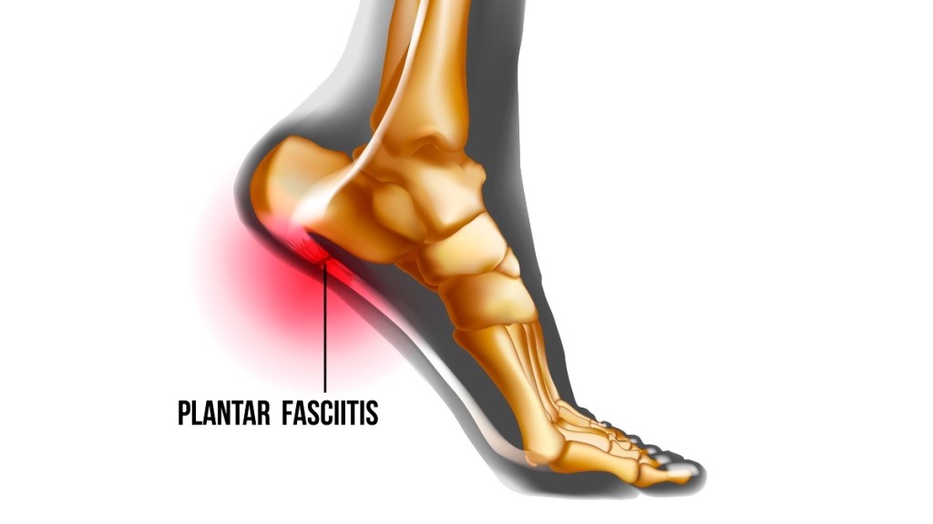An illustration of plantar fasciitis, which can be soothed with insoles