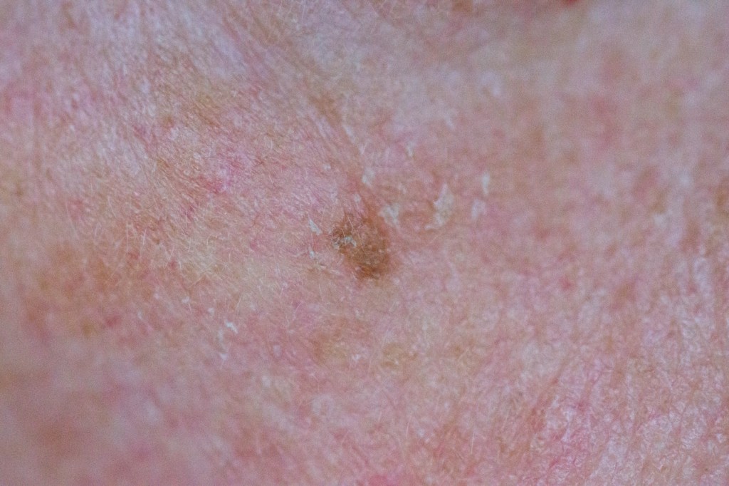 Senior male patient with a Keratosis on his cheek, under his right eye, the skin blemish is probably sun damage related.