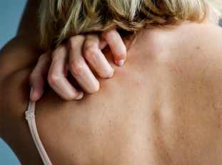 woman scratching her back: keto rash