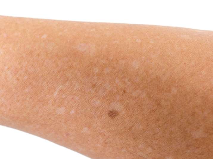 Are Those White Spots On Your Skin From Sun?