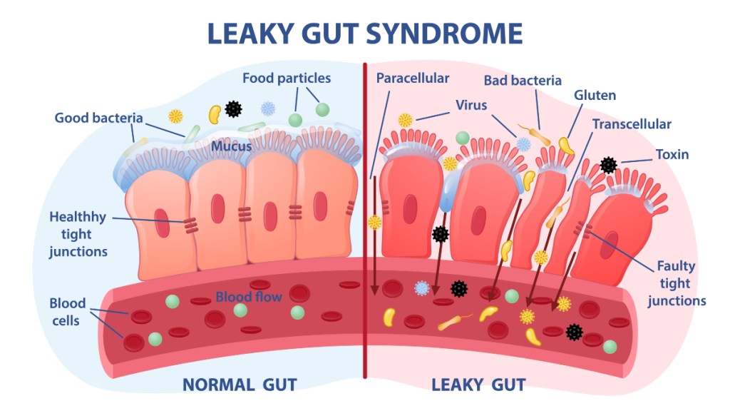 An illustration of leaky gut syndrome