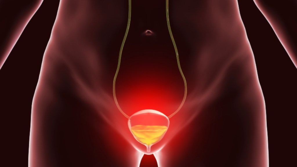An illustration of an irritated bladder, a symptom of interstitial cystitis