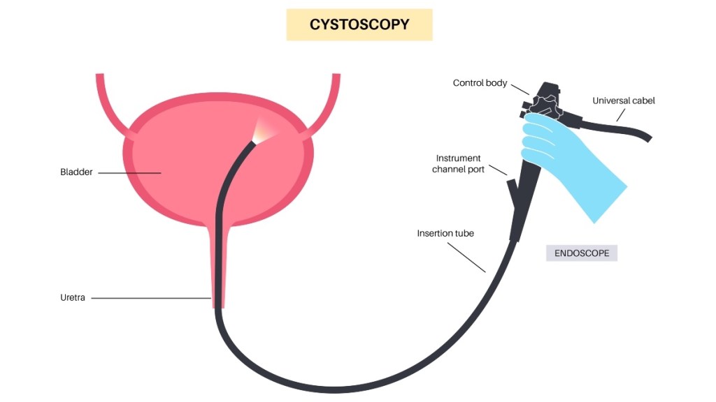 An illustration of a cystoscopy, which can help diagnose interstitial cystitis