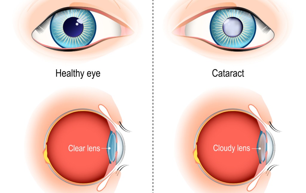 An illustration of cataracts, which a person can prevent naturally