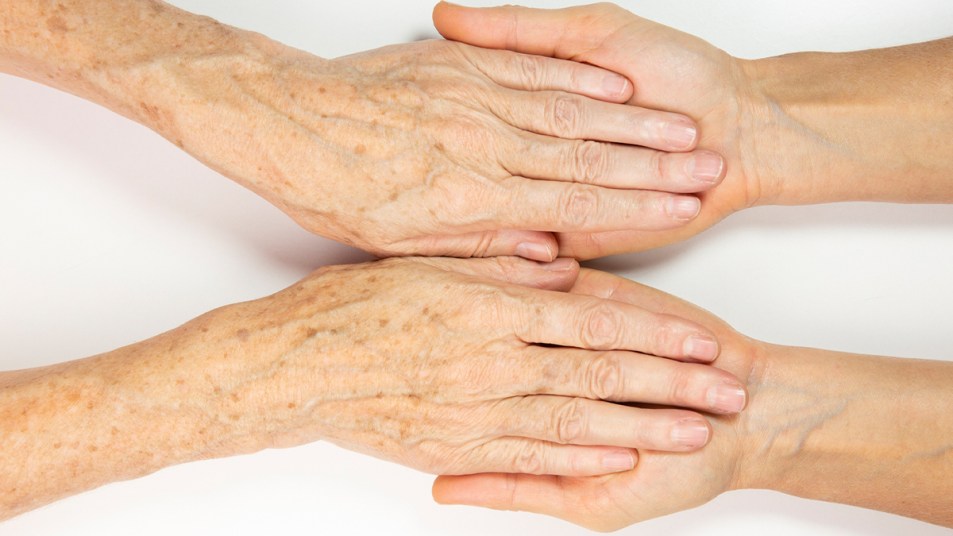 Woman with age spots on her hands and arms