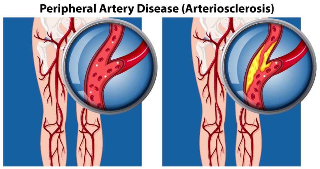 An illustration of peripheral artery disease, which can cause symptoms like shiny skin on legs