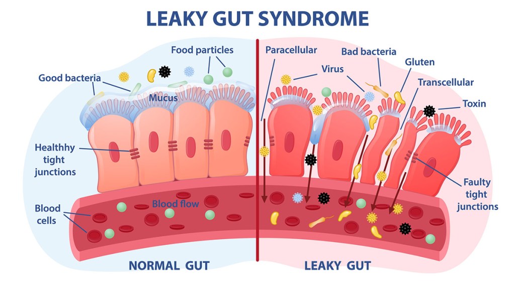 Medical illustration of a leaky gut, which fruits can help heal