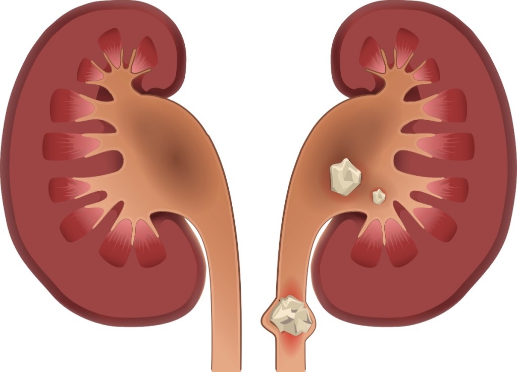 An illustration of kidney stones