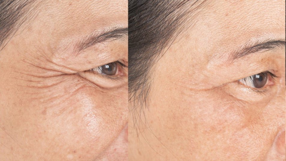 senior woman with puffy eyes and crows feet, before and after skin treatment, Instant FIRMx concept