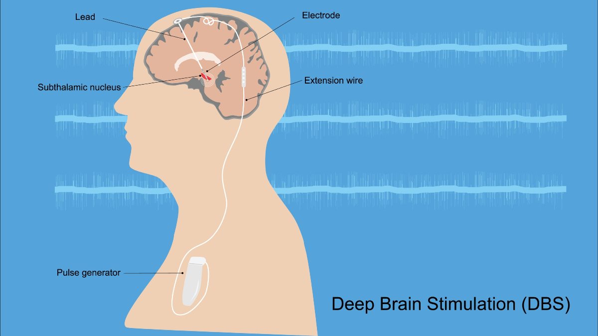 Illustration of deep brain stimulation, profile of human with diagram of brain and electrodes against a blue background