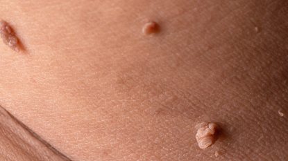 close up of three skin tags on skin