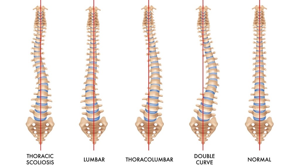 An illustration of types of scoliosis 