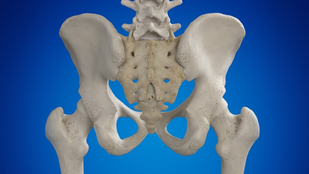 An illustration of uneven hips caused by a proximal femur imbalance