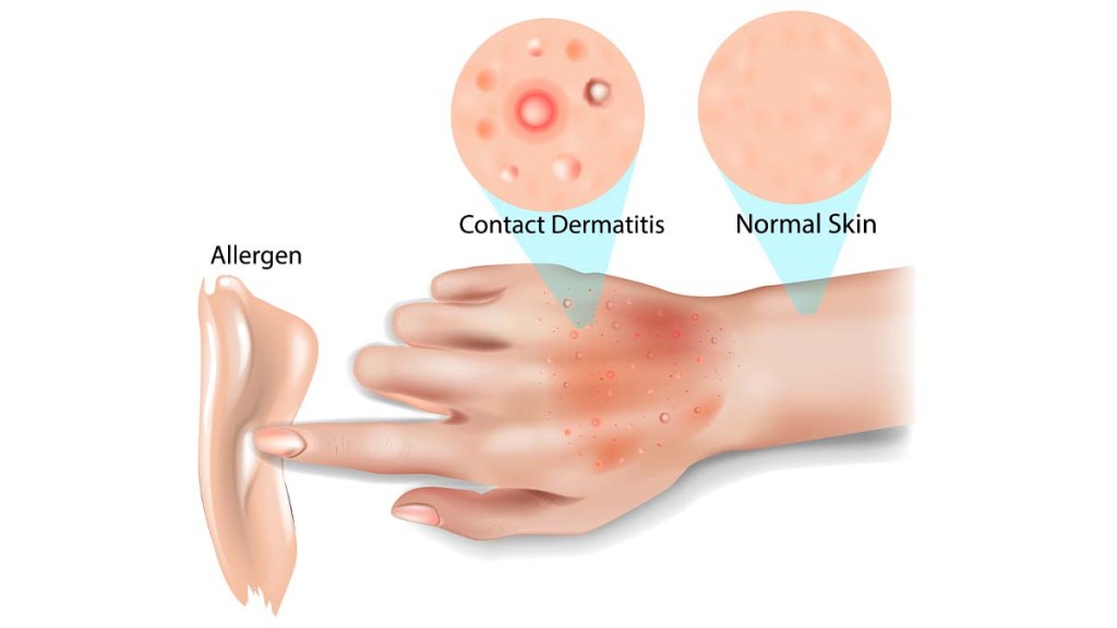 Allergic contact dermatitis graph