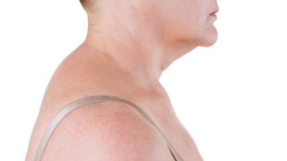 A woman with a neck hump, also known as kyphosis