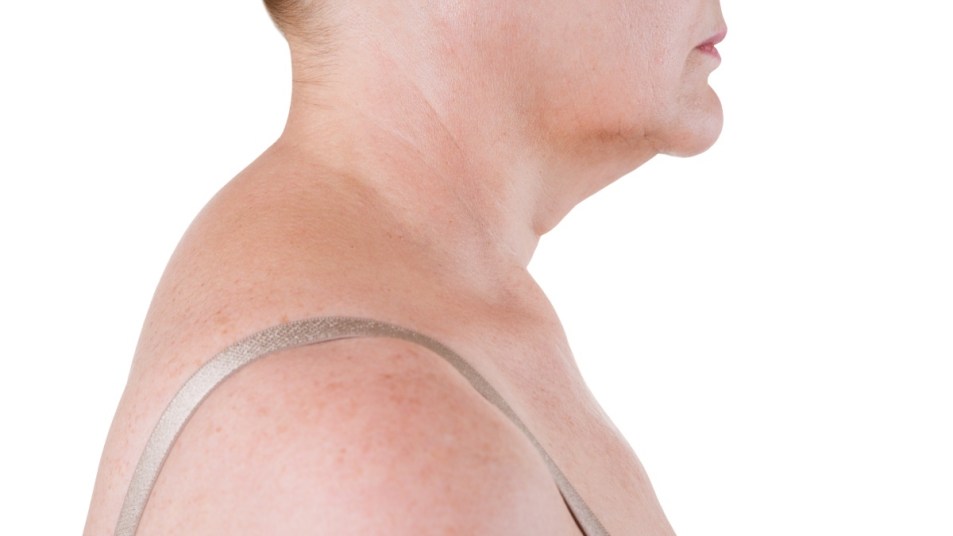 A woman with a neck hump, also known as kyphosis