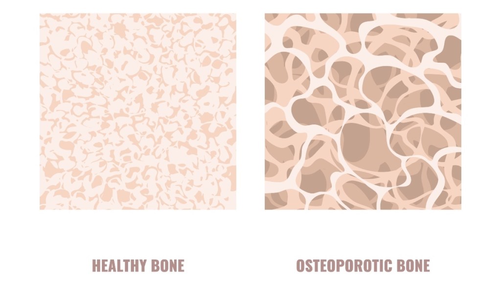 An illustration of bones with osteoporosis
