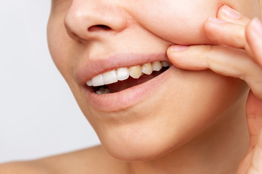 yellow tooth stain