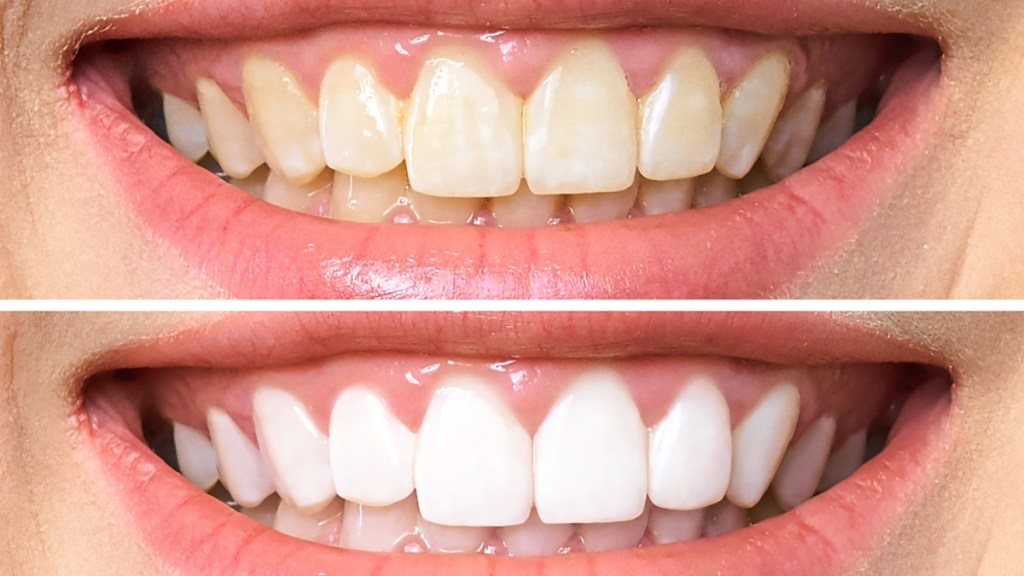 Dişleri Beyazlatmanın 5 Hızlı Kendin Yap Yolu