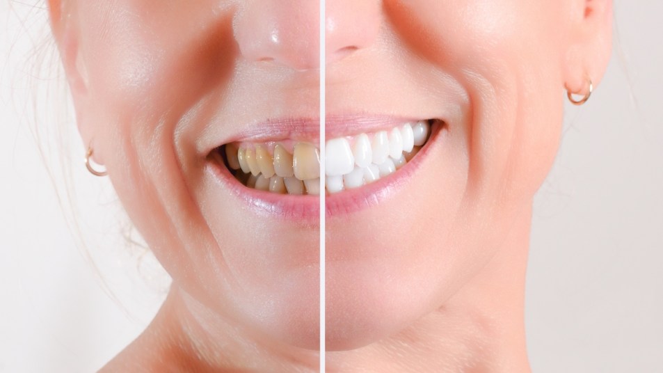 close up on mature woman's teeth, before and after a dental treatment