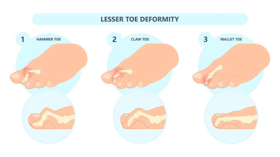 lesser toe deformities graphic, hammer toe, claw toe, mallet toe