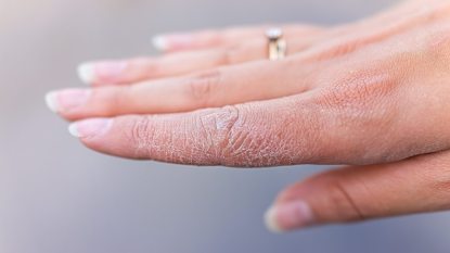 white woman's dry hand