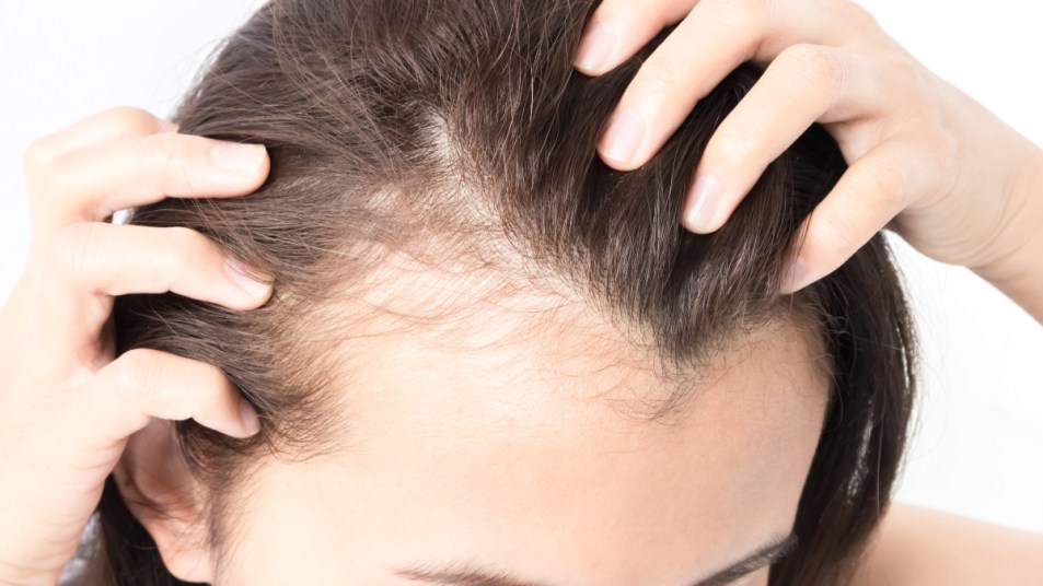 woman with hair loss, a potential symptom of mold toxicity