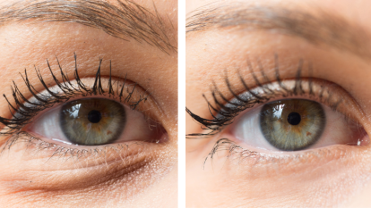 beauty treatments concept, close up of eye bags before and after