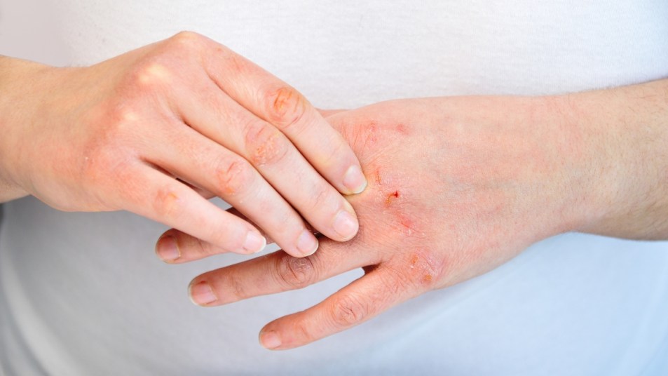 close up on mature white woman's hands with redness, eczema