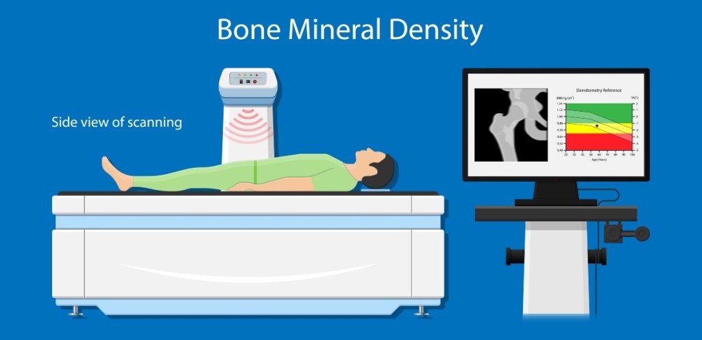 A DEXA scan to check for osteoporosis, which can be prevented with foods and exercise