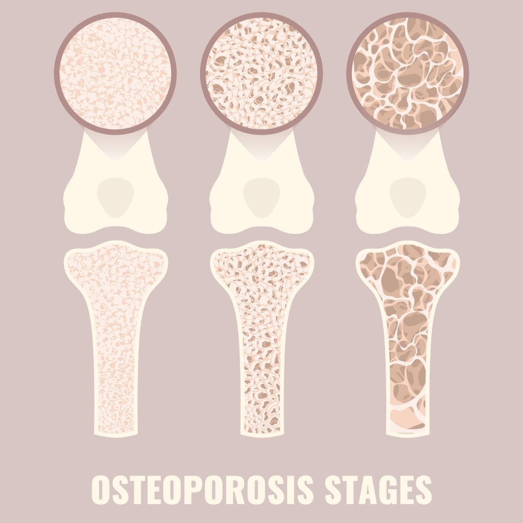 How osteoporosis can be prevented with foods and exercise