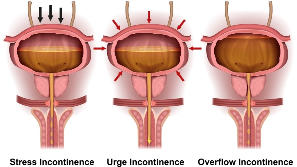 An illustration of different types of urinary incontinence, which can be helped with home treatment