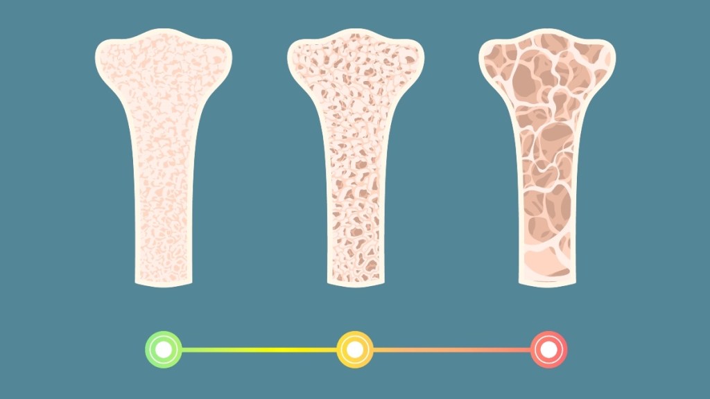 An illustration of the stage of osteoporosis