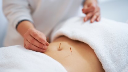 Woman receiving acupuncture treatment on abdomen