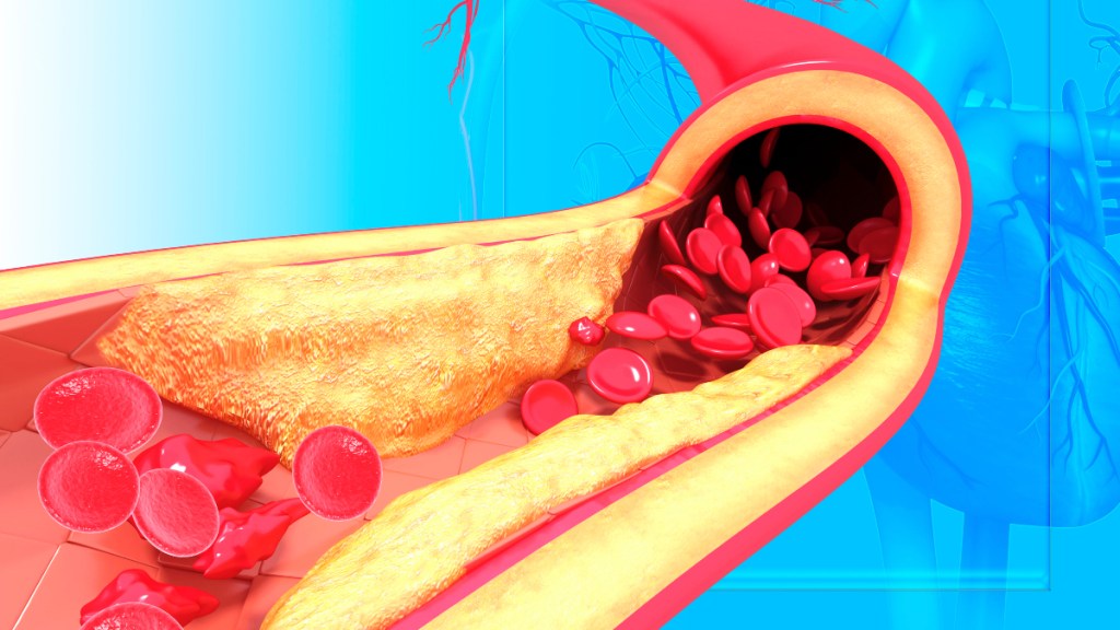 An illustration of plaque building in arteries, which is why heart disease prevention for women is so important