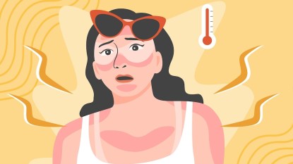 Illustration of woman with sunburn on her face and body